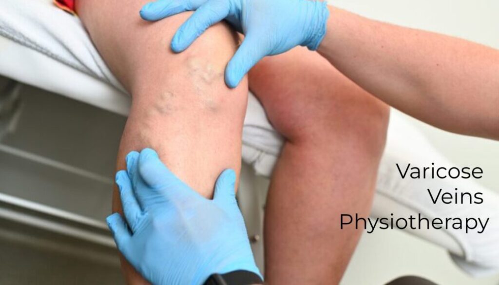 Varicose Veins Physiotherapy